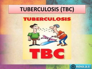 TUBERCULOSIS (TBC)
nova.a.s
 