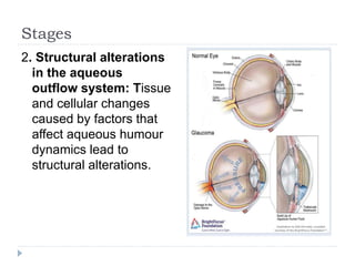 Stages
2. Structural alterations
in the aqueous
outflow system: Tissue
and cellular changes
caused by factors that
affect aqueous humour
dynamics lead to
structural alterations.
 