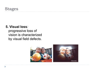 5. Visual loss:
progressive loss of
vision is characterized
by visual field defects.
Stages
 