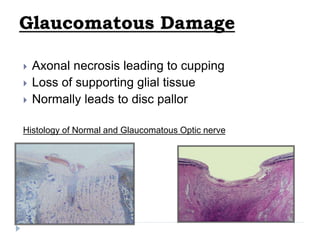 Glaucomatous Damage
 Axonal necrosis leading to cupping
 Loss of supporting glial tissue
 Normally leads to disc pallor
Histology of Normal and Glaucomatous Optic nerve
 