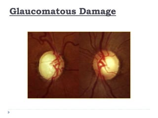 Glaucomatous Damage
 