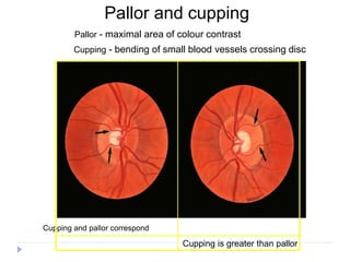 Pallor and cupping
Cupping and pallor correspond
Pallor - maximal area of colour contrast
Cupping is greater than pallor
Cupping - bending of small blood vessels crossing disc
 