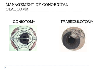 MANAGEMENT OF CONGENITAL
GLAUCOMA
GONIOTOMY TRABECULOTOMY
 
