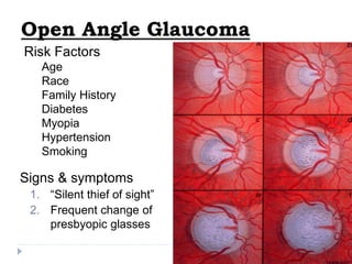 Signs & symptoms
1. “Silent thief of sight”
2. Frequent change of
presbyopic glasses
Open Angle Glaucoma
Risk Factors
Age
Race
Family History
Diabetes
Myopia
Hypertension
Smoking
 