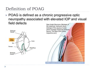 Definition of POAG
 POAG is defined as a chronic progressive optic
neuropathy associated with elevated IOP and visual
field defects
 