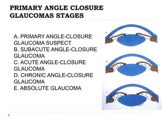 PRIMARY ANGLE CLOSURE
GLAUCOMAS STAGES
A. PRIMARY ANGLE-CLOSURE
GLAUCOMA SUSPECT
B. SUBACUTE ANGLE-CLOSURE
GLAUCOMA
C. ACUTE ANGLE-CLOSURE
GLAUCOMA
D. CHRONIC ANGLE-CLOSURE
GLAUCOMA
E. ABSOLUTE GLAUCOMA
 