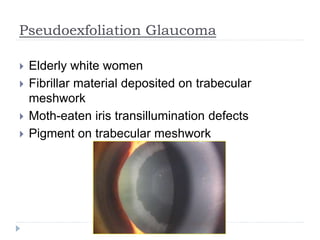 Pseudoexfoliation Glaucoma
 Elderly white women
 Fibrillar material deposited on trabecular
meshwork
 Moth-eaten iris transillumination defects
 Pigment on trabecular meshwork
 