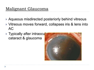 Malignant Glaucoma
 Aqueous misdirected posteriorly behind vitreous
 Vitreous moves forward, collapses iris & lens into
AC
 Typically after intraocular surgery particularly
cataract & glaucoma
 
