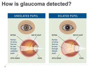 How is glaucoma detected?
 
