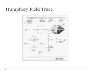 Humphery Field Trace
 