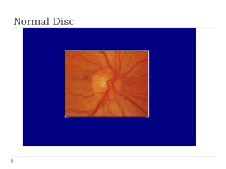 Normal Disc
 