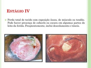 ESTÁGIO IV
 Perda total de tecido com exposição óssea, de músculo ou tendão.
Pode haver presença de esfacelo ou escara em algumas partes do
leito da ferida. Freqüentemente, inclui descolamento e túneis.
 