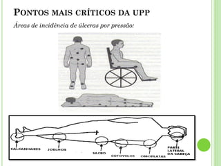 Áreas de incidência de úlceras por pressão:
PONTOS MAIS CRÍTICOS DA UPP
 