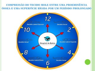 COMPRESSÃO DO TECIDO MOLE ENTRE UMA PROEMINÊNCIA
ÓSSEA E UMA SUPERFÍCIE RÍGIDA POR UM PERÍODO PROLONGADO
 