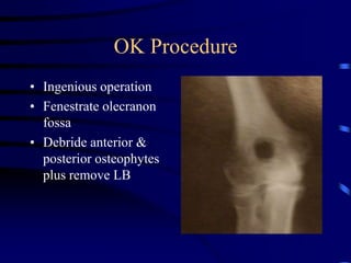 OK ProcedureIngenious operationFenestrate olecranon fossaDebride anterior & posterior osteophytes plus remove LB