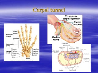 Carpal tunnel
 