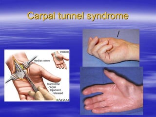 Carpal tunnel syndrome
 