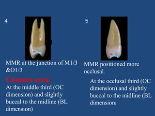4 5
Contact area:
At the middle third (OC
dimension) and slightly
buccal to the midline (BL
dimension)
At the occlusal third (OC
dimension) and slightly
buccal to the midline (BL
dimension)
MMR at the junction of M1/3
&O1/3
MMR positioned more
occlusal.
 