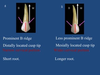 4 5
M
D D M
Prominent B ridge
Distally located cusp tip
Less prominent B ridge
Mesially located cusp tip
Narrow cervical portion. Wider cervical portion.
Short root. Longer root.
 