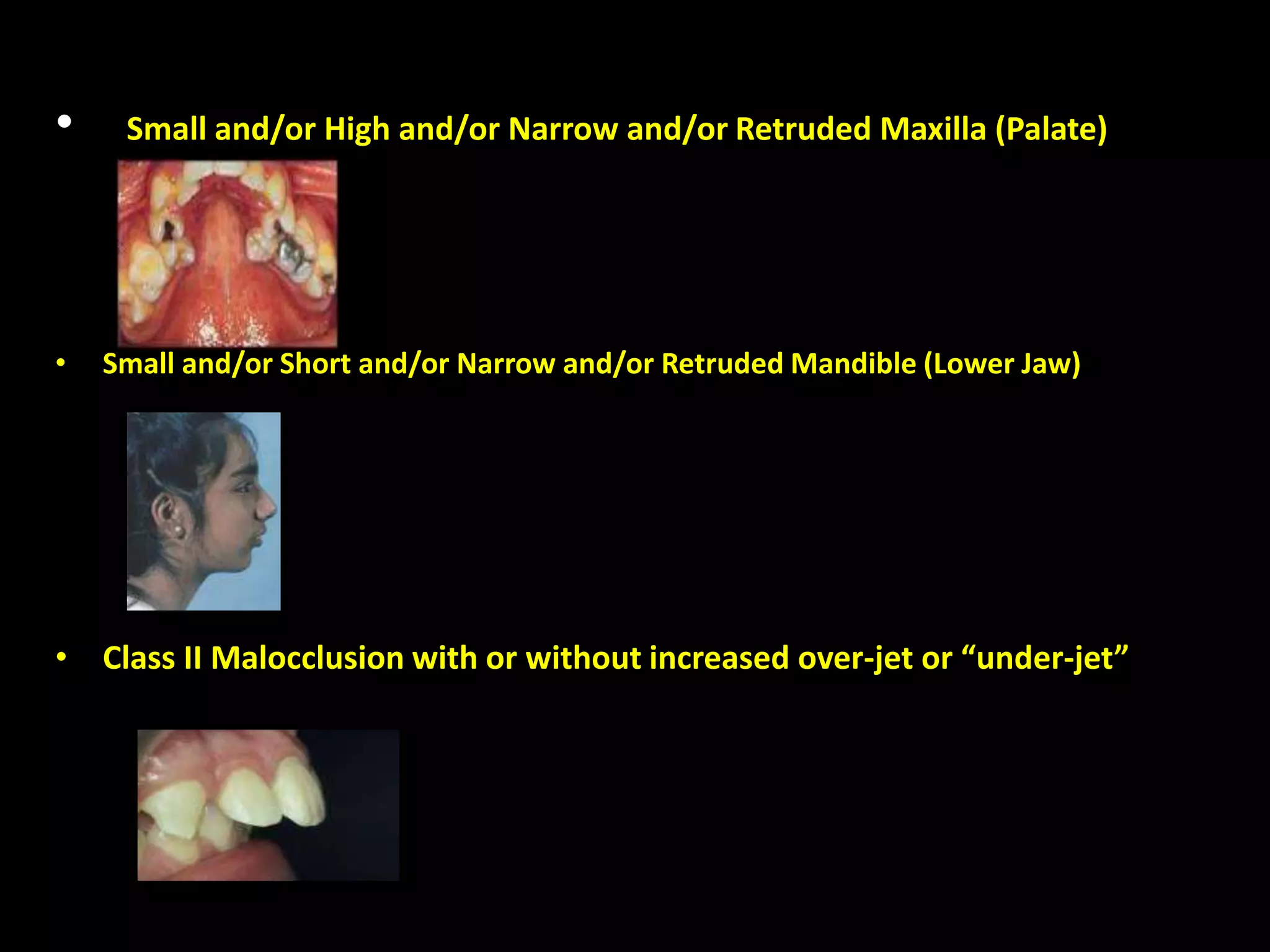 • Small and/or High and/or Narrow and/or Retruded Maxilla (Palate)
• Small and/or Short and/or Narrow and/or Retruded Mandible (Lower Jaw)
• Class II Malocclusion with or without increased over-jet or “under-jet”
 