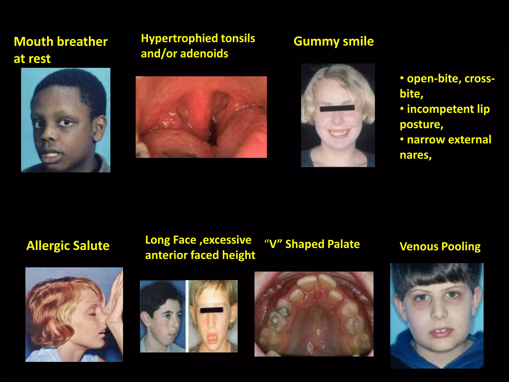 Mouth breather
at rest
:
Gummy smile
Long Face ,excessive
anterior faced height
Hypertrophied tonsils
and/or adenoids
Allergic Salute “V” Shaped Palate Venous Pooling
• open-bite, cross-
bite,
• incompetent lip
posture,
• narrow external
nares,
 