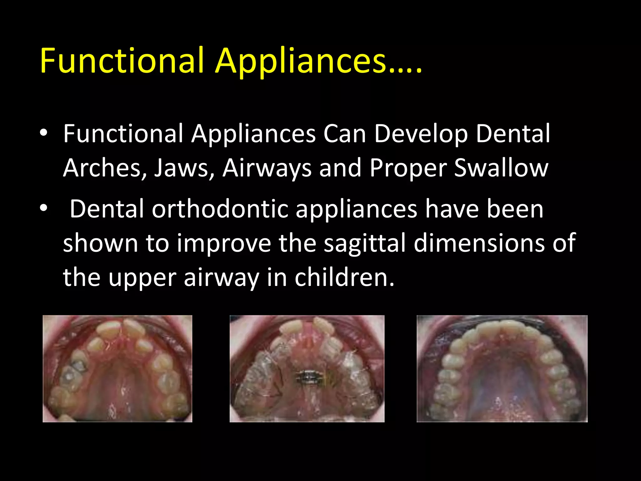 Functional Appliances….
• Functional Appliances Can Develop Dental
Arches, Jaws, Airways and Proper Swallow
• Dental orthodontic appliances have been
shown to improve the sagittal dimensions of
the upper airway in children.
 
