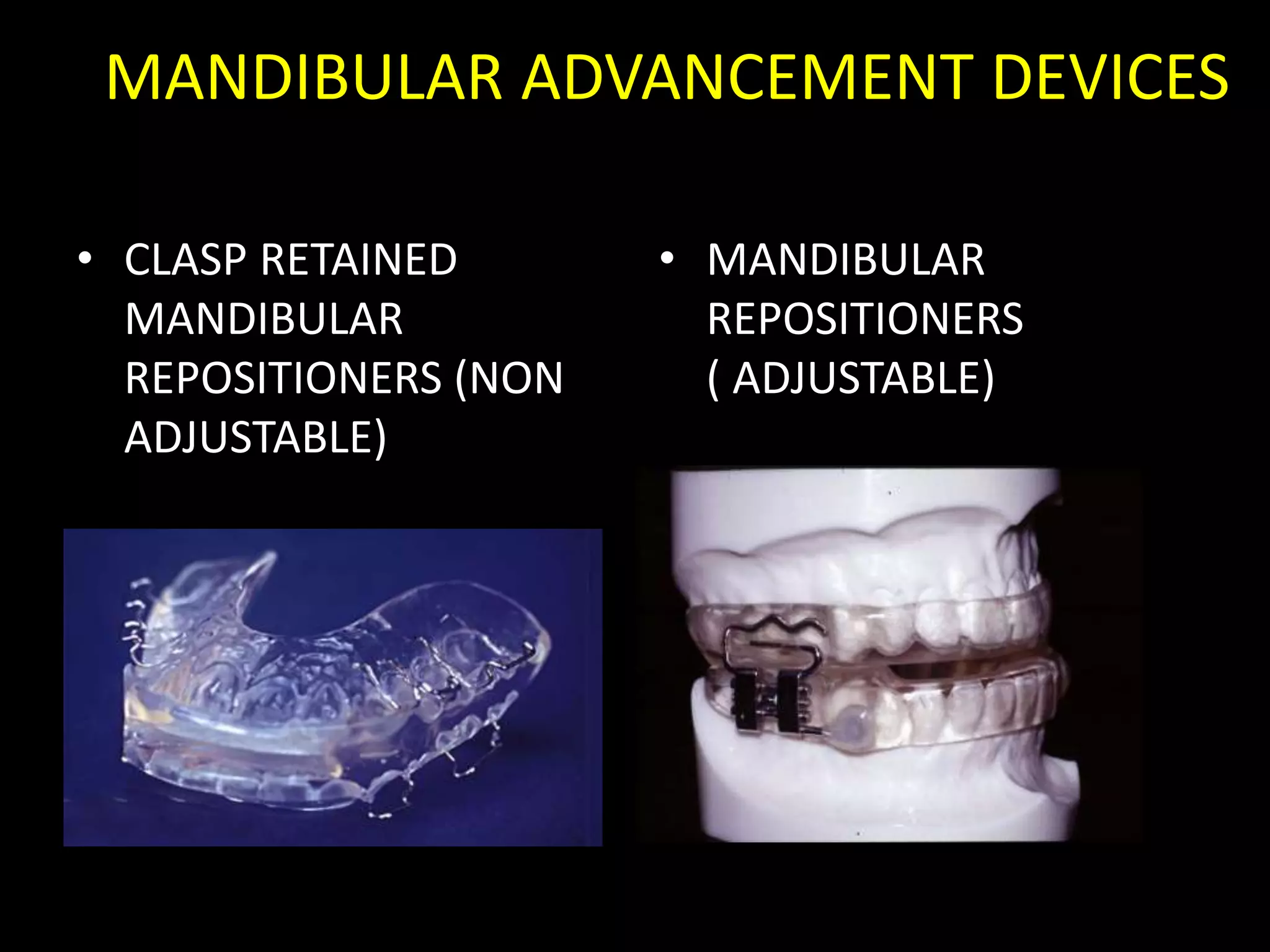MANDIBULAR ADVANCEMENT DEVICES
• CLASP RETAINED
MANDIBULAR
REPOSITIONERS (NON
ADJUSTABLE)
• MANDIBULAR
REPOSITIONERS
( ADJUSTABLE)
 