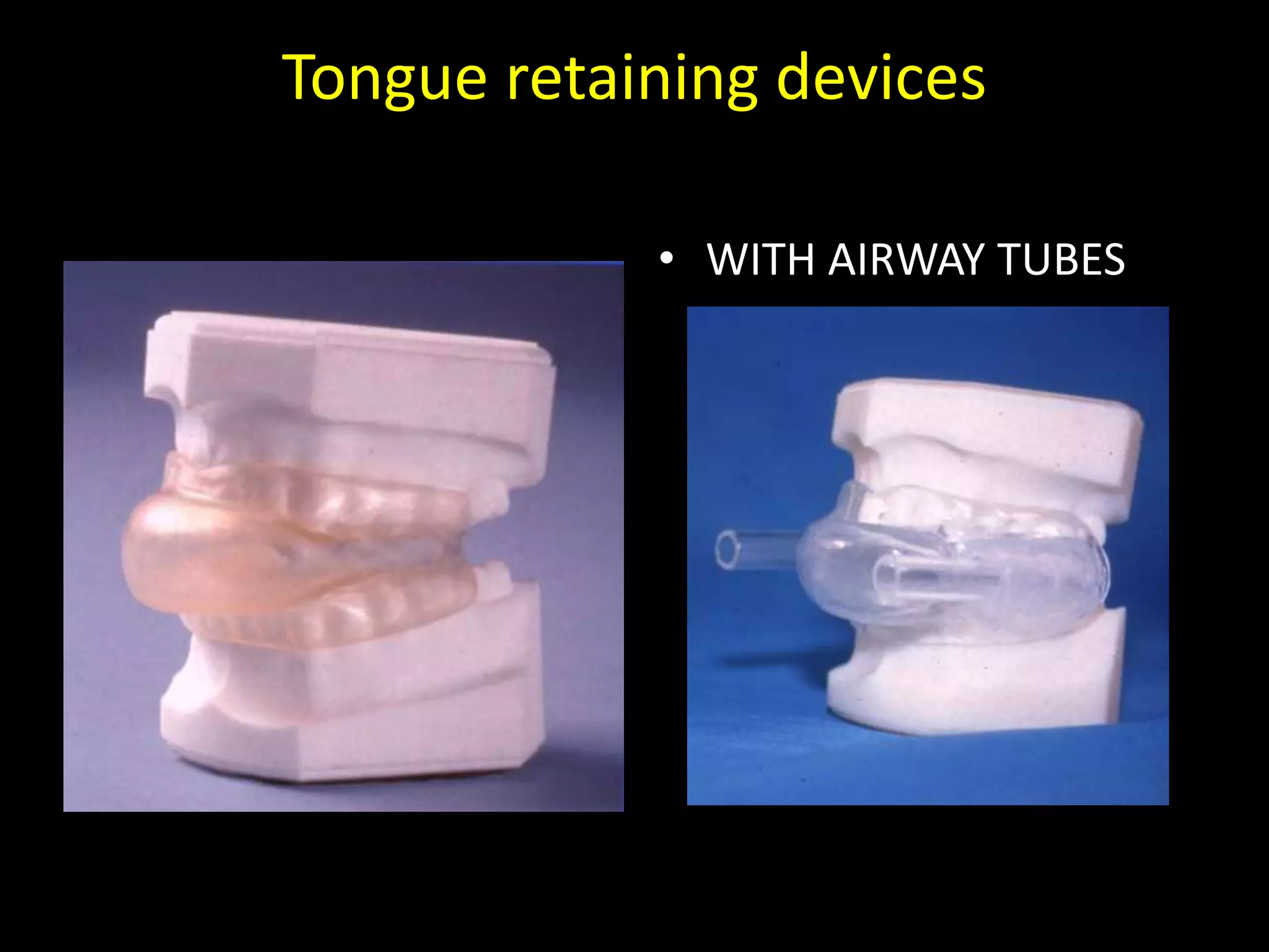 Tongue retaining devices
• WITH AIRWAY TUBES
 
