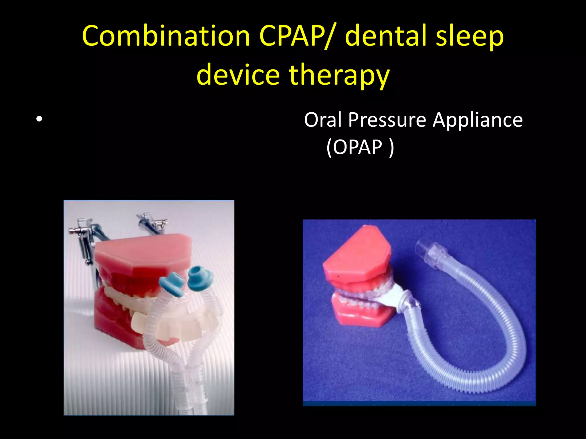 Combination CPAP/ dental sleep
device therapy
• Oral Pressure Appliance
(OPAP )
 
