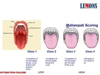 Upper airway assessment east iv | PPT