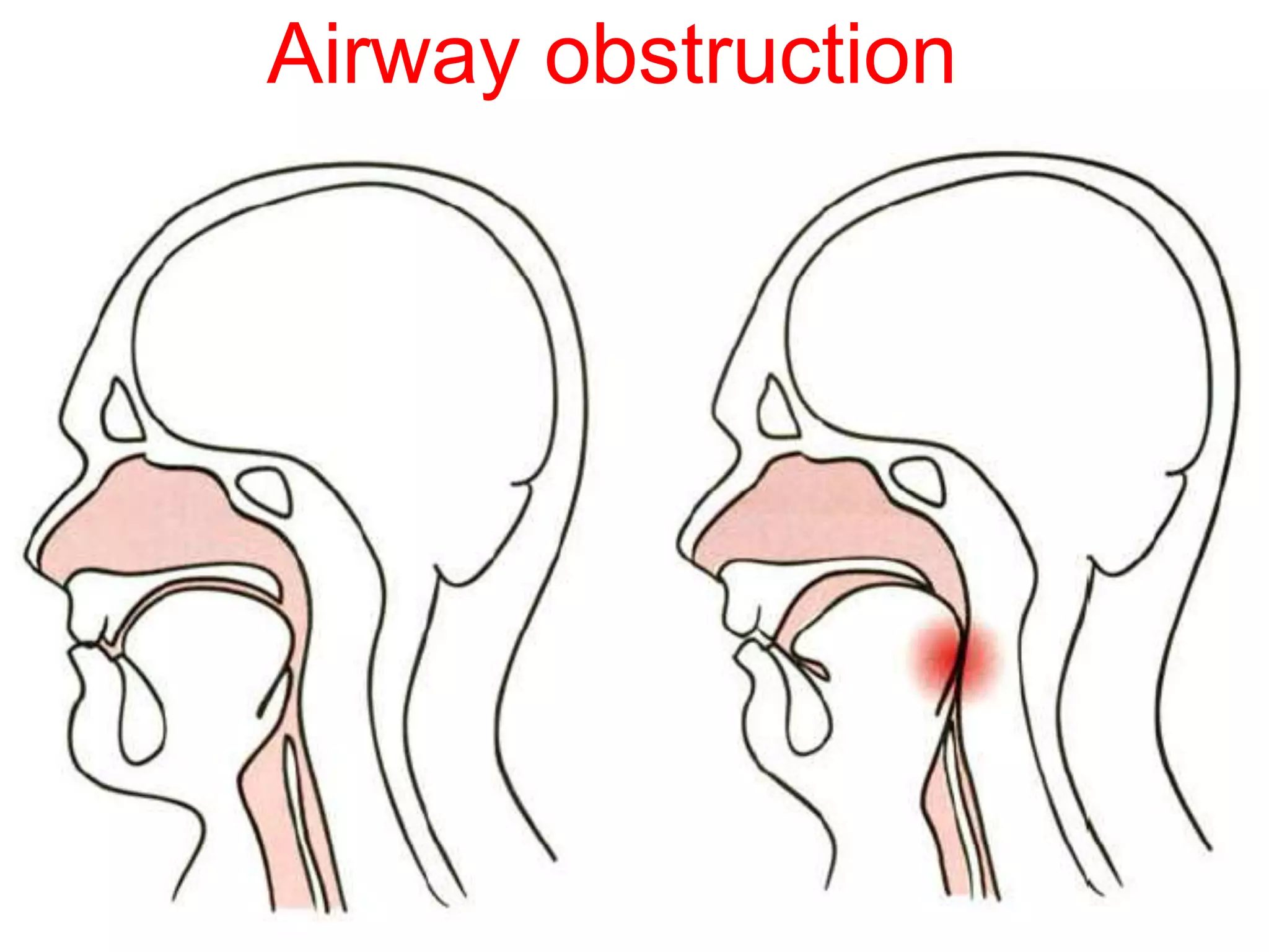 Upper Airway Management PPTX Upper Airway Management PPTX
