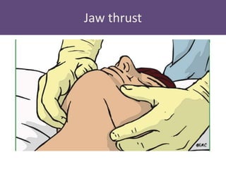 Upper airway management | PPTX