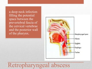 Retropharyngeal abscess
• a deep neck infection
filling the potential
space between the
prevertebral fascia of
the cervical vertebrae
and the posterior wall
of the pharynx.
 