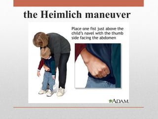 the Heimlich maneuver
 