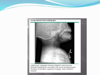UPPER AIRWAY OBSTRUCTION.pptx