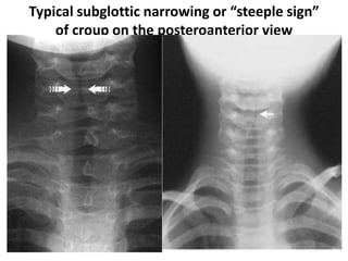 Typical subglottic narrowing or “steeple sign”
of croup on the posteroanterior view
 