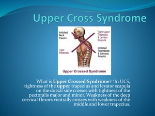 What is Upper Crossed Syndrome? “In UCS,
tightness of the upper trapezius and levator scapula
on the dorsal side crosses with tightness of the
pectoralis major and minor. Weakness of the deep
cervical flexors ventrally crosses with weakness of the
middle and lower trapezius.
 