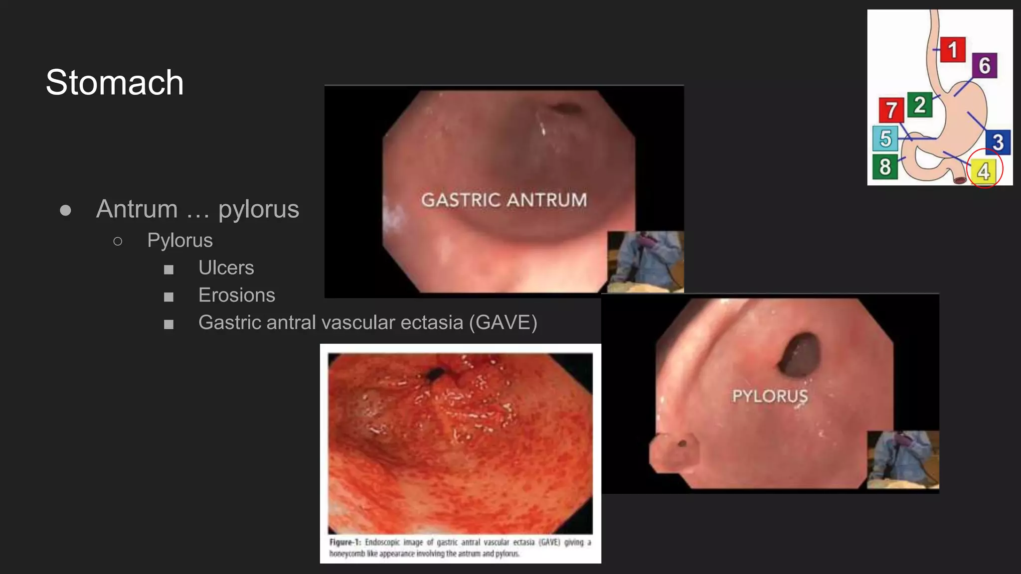 Stomach
● Antrum … pylorus
○ Pylorus
■ Ulcers
■ Erosions
■ Gastric antral vascular ectasia (GAVE)
 