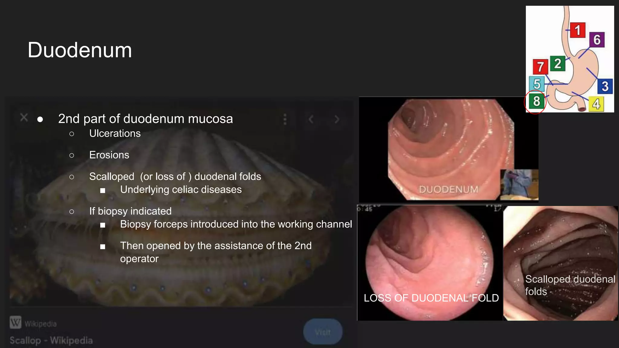 ● 2nd part of duodenum mucosa
○ Ulcerations
○ Erosions
○ Scalloped (or loss of ) duodenal folds
■ Underlying celiac diseases
○ If biopsy indicated
■ Biopsy forceps introduced into the working channel
■ Then opened by the assistance of the 2nd
operator
Duodenum
LOSS OF DUODENAL FOLD
Scalloped duodenal
folds
 