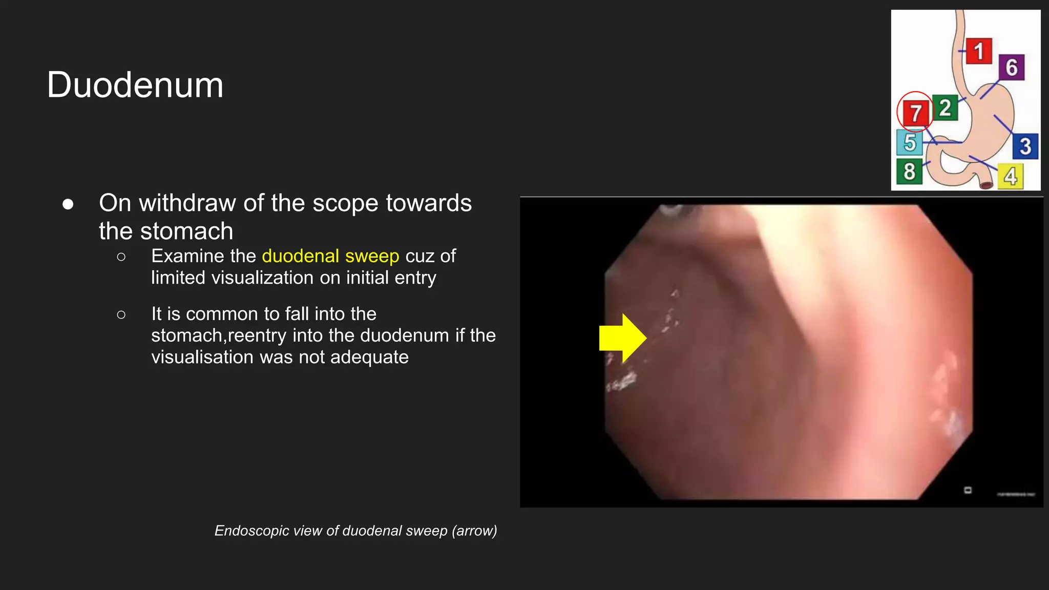 ● On withdraw of the scope towards
the stomach
○ Examine the duodenal sweep cuz of
limited visualization on initial entry
○ It is common to fall into the
stomach,reentry into the duodenum if the
visualisation was not adequate
Duodenum
Endoscopic view of duodenal sweep (arrow)
 