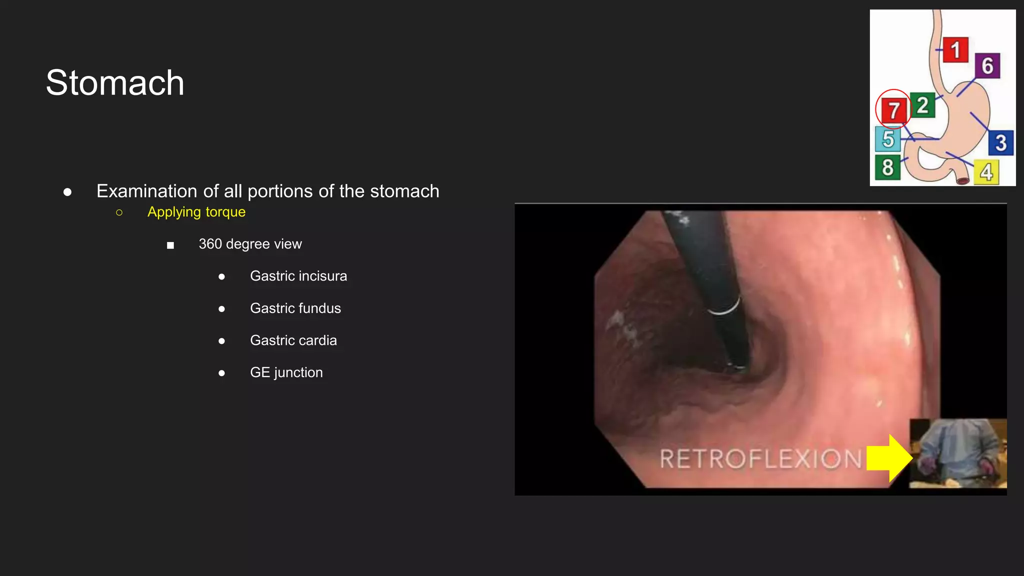 ● Examination of all portions of the stomach
○ Applying torque
■ 360 degree view
● Gastric incisura
● Gastric fundus
● Gastric cardia
● GE junction
Stomach
 