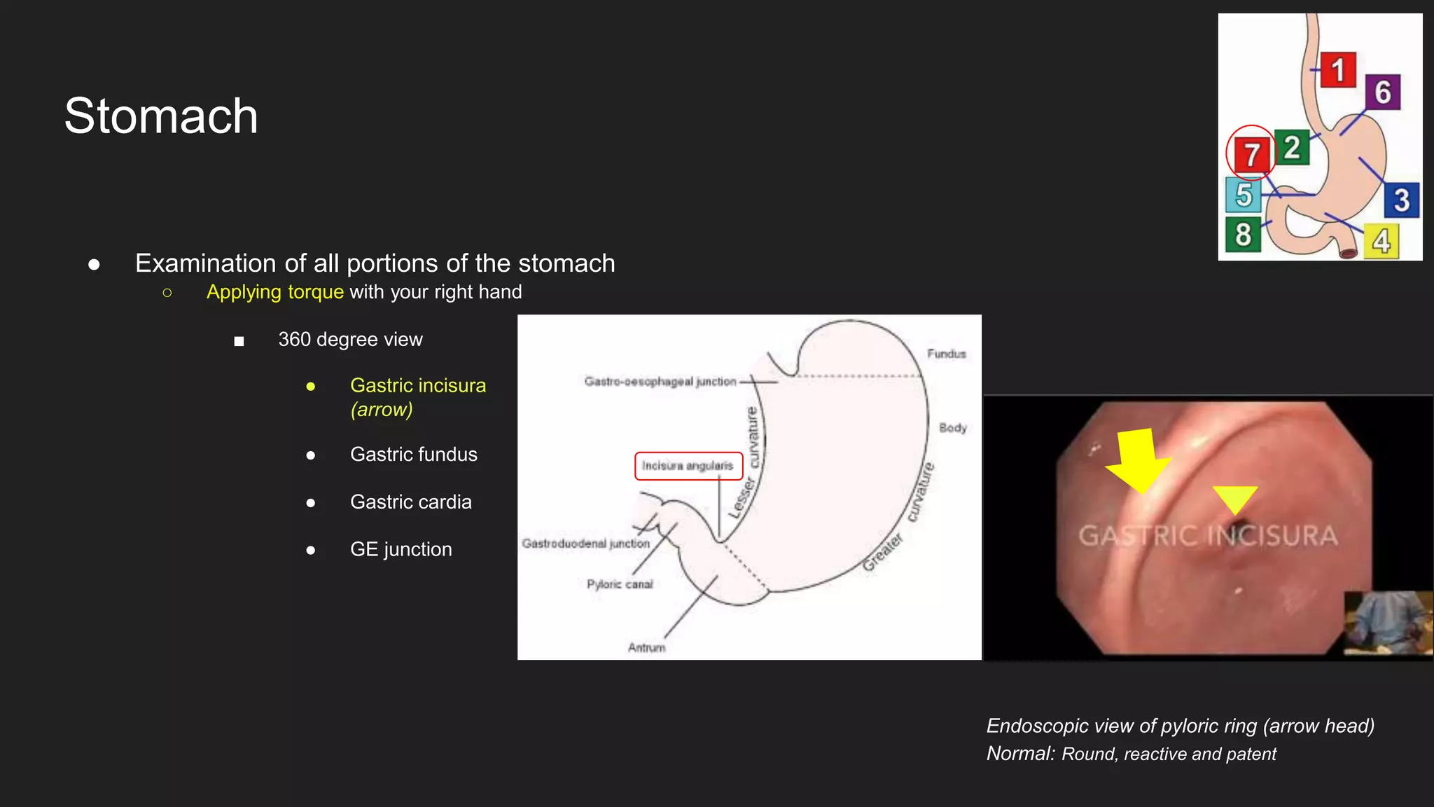 ● Examination of all portions of the stomach
○ Applying torque with your right hand
■ 360 degree view
● Gastric incisura
(arrow)
● Gastric fundus
● Gastric cardia
● GE junction
Stomach
Endoscopic view of pyloric ring (arrow head)
Normal: Round, reactive and patent
 