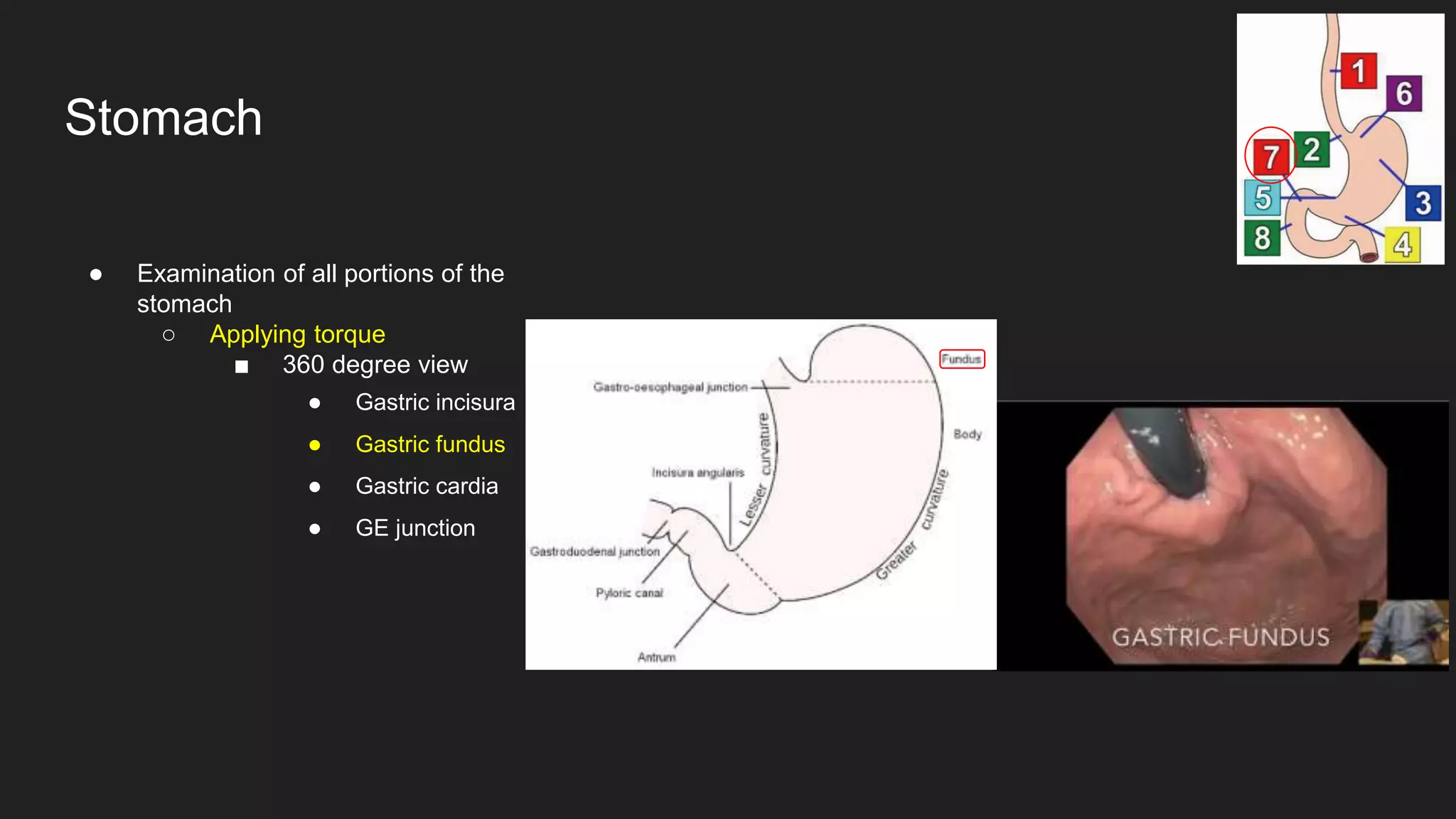 ● Examination of all portions of the
stomach
○ Applying torque
■ 360 degree view
● Gastric incisura
● Gastric fundus
● Gastric cardia
● GE junction
Stomach
 