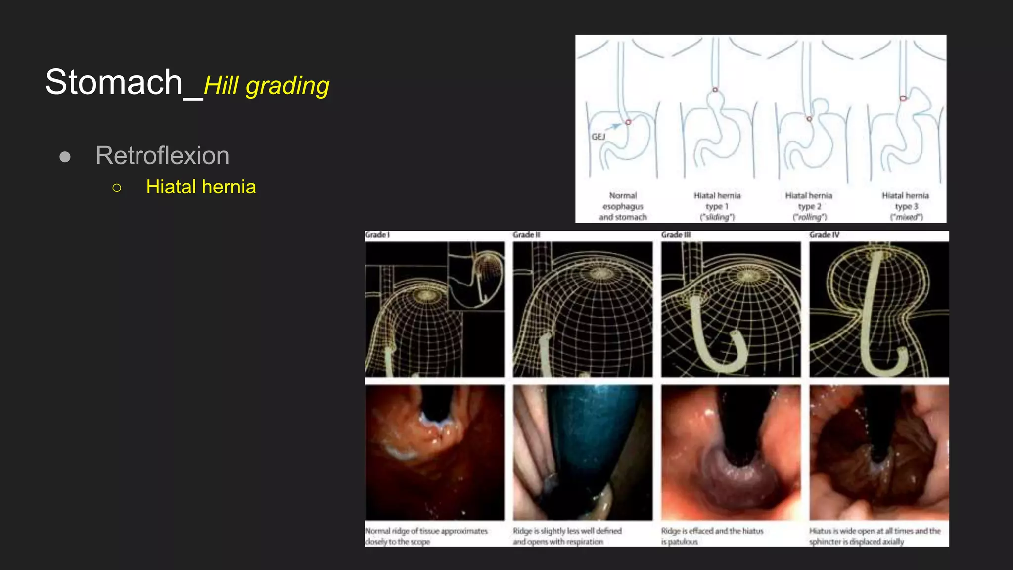 Stomach_Hill grading
● Retroflexion
○ Hiatal hernia
 