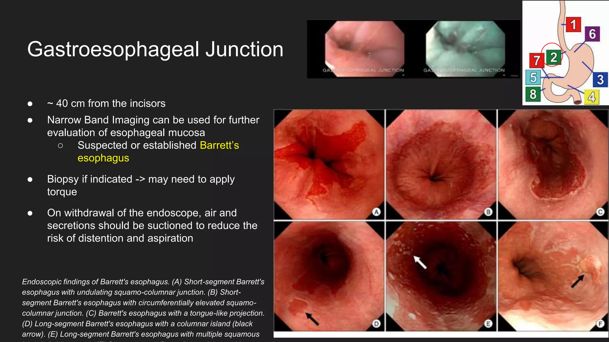 ● ~ 40 cm from the incisors
● Narrow Band Imaging can be used for further
evaluation of esophageal mucosa
○ Suspected or established Barrett’s
esophagus
● Biopsy if indicated -> may need to apply
torque
● On withdrawal of the endoscope, air and
secretions should be suctioned to reduce the
risk of distention and aspiration
Gastroesophageal Junction
Endoscopic findings of Barrett's esophagus. (A) Short-segment Barrett's
esophagus with undulating squamo-columnar junction. (B) Short-
segment Barrett's esophagus with circumferentially elevated squamo-
columnar junction. (C) Barrett's esophagus with a tongue-like projection.
(D) Long-segment Barrett's esophagus with a columnar island (black
arrow). (E) Long-segment Barrett's esophagus with multiple squamous
 