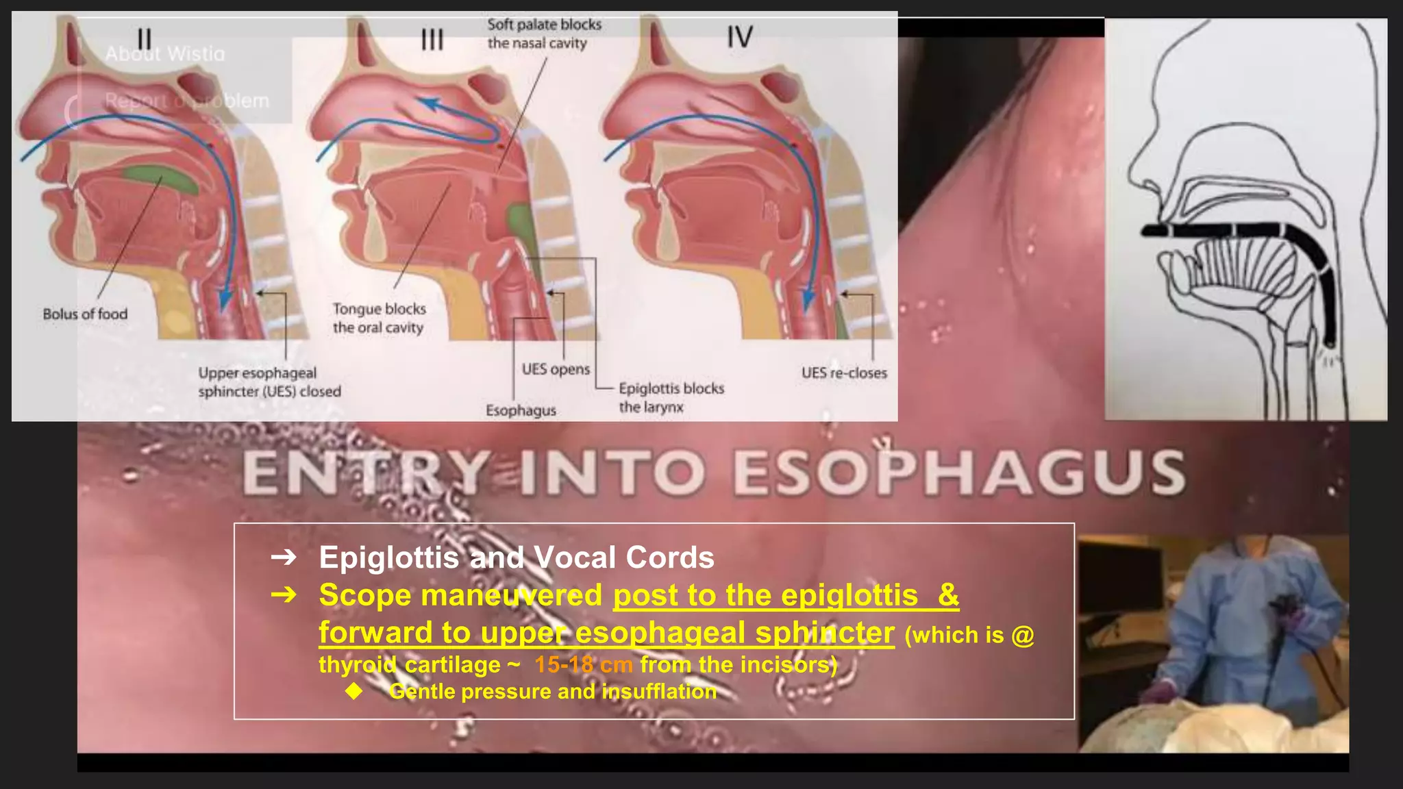 Common anatomical landmarks
➔ Epiglottis and Vocal Cords
➔ Scope maneuvered post to the epiglottis &
forward to upper esophageal sphincter (which is @
thyroid cartilage ~ 15-18 cm from the incisors)
◆ Gentle pressure and insufflation
 