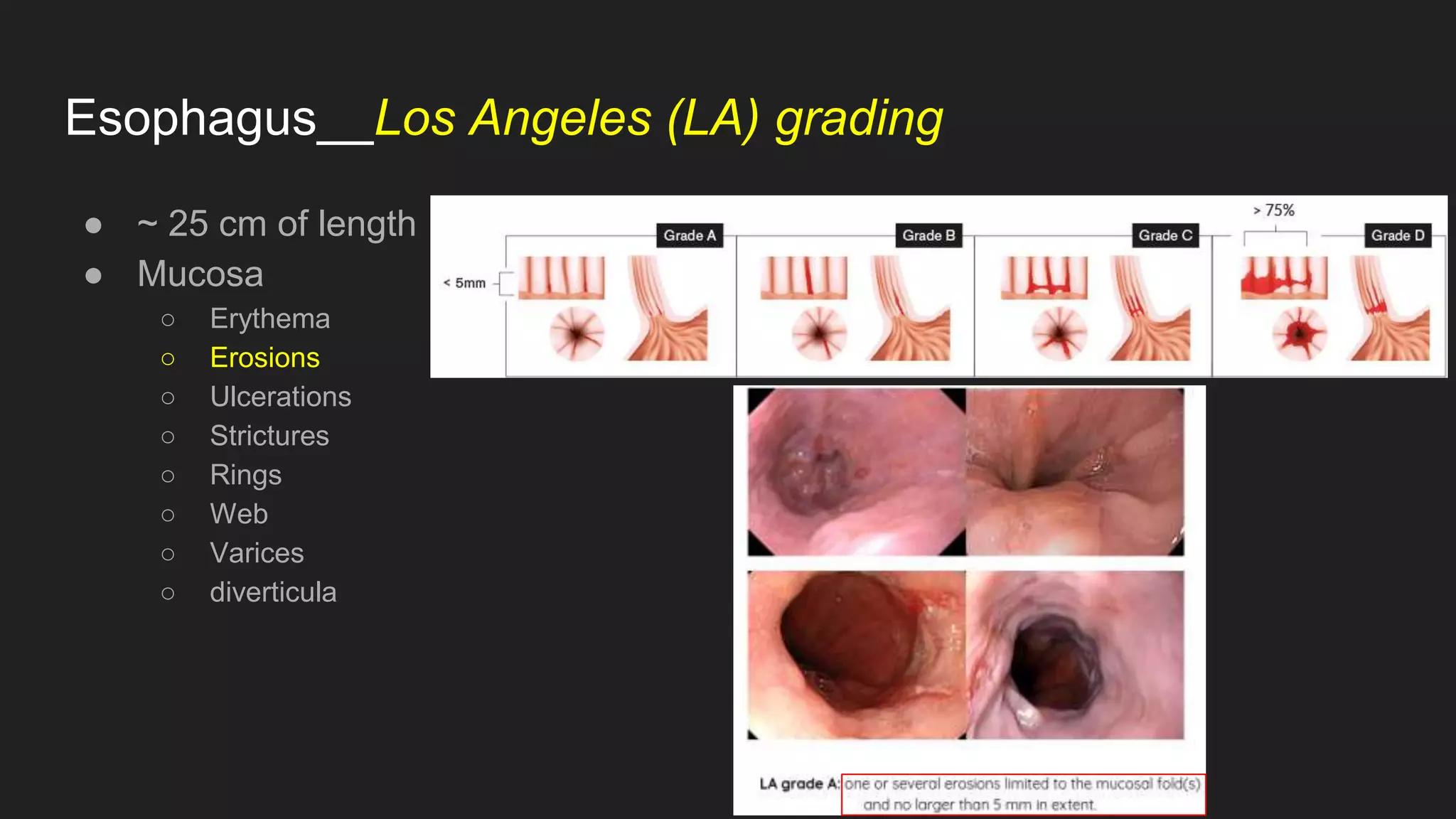 Esophagus__Los Angeles (LA) grading
● ~ 25 cm of length
● Mucosa
○ Erythema
○ Erosions
○ Ulcerations
○ Strictures
○ Rings
○ Web
○ Varices
○ diverticula
 