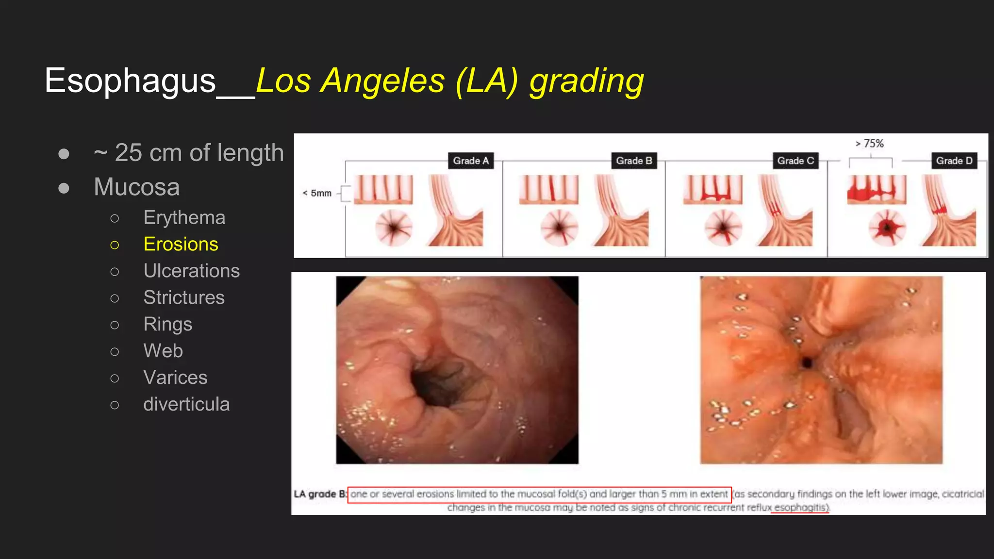 Esophagus__Los Angeles (LA) grading
● ~ 25 cm of length
● Mucosa
○ Erythema
○ Erosions
○ Ulcerations
○ Strictures
○ Rings
○ Web
○ Varices
○ diverticula
 