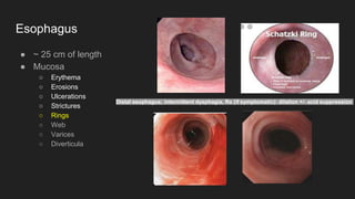 Esophagus
● ~ 25 cm of length
● Mucosa
○ Erythema
○ Erosions
○ Ulcerations
○ Strictures
○ Rings
○ Web
○ Varices
○ Diverticula
Distal esophagus; intermittent dysphagia, Rx (if symptomatic): dilation +/- acid suppression
 