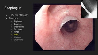 Esophagus
● ~ 25 cm of length
● Mucosa
○ Erythema
○ Erosions
○ Ulcerations
○ Strictures
○ Rings
○ Web
○ Varices
○ Diverticula
 